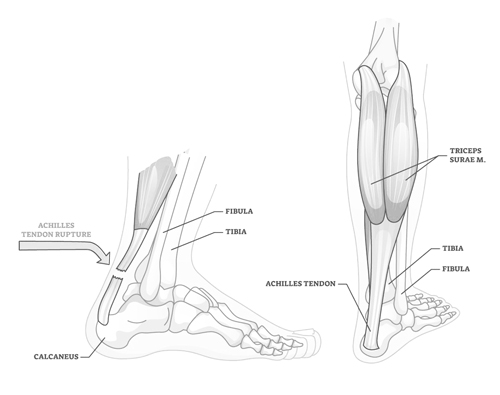 Achilles Tendon