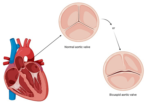 Bicuspid Valve