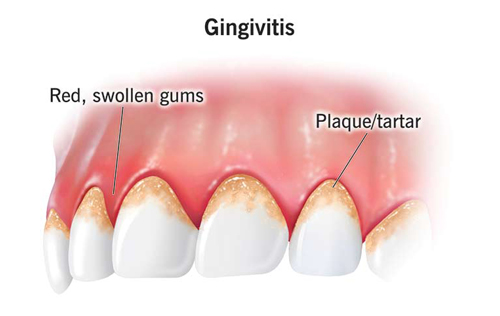 Gums