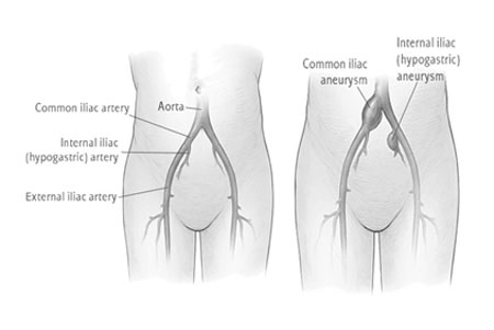 Iliac Artery