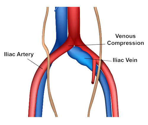 Iliac Vein