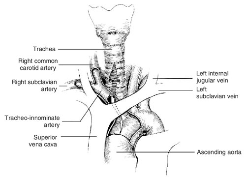 Innominate Artery