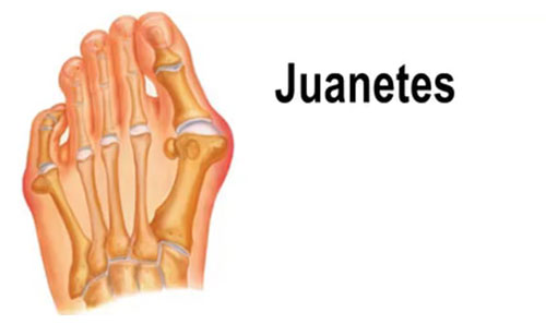 Juanetes