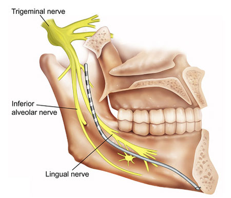 Lingual Nerve