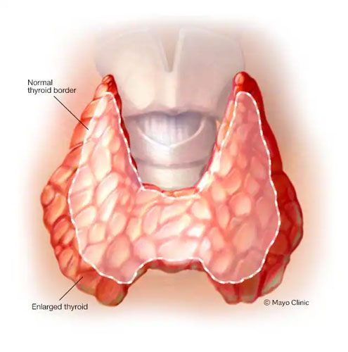 Thyroid